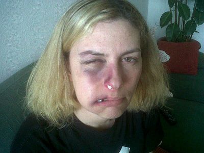 Le immagini di Cristina Quaranta dopo la rissa